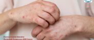 Pennsylvania Measles Outbreak Surpasses 800 Cases | Healthcare Times Magazine