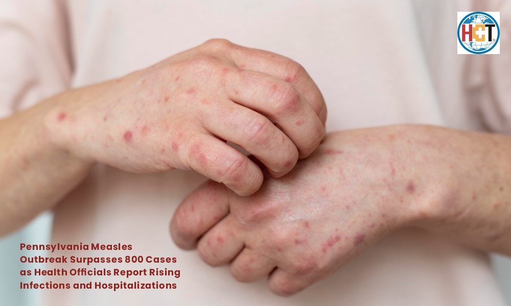 Pennsylvania Measles Outbreak Surpasses 800 Cases | Healthcare Times Magazine