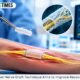 Novel Nerve Graft Technique Aims to Improve Recovery 80x80